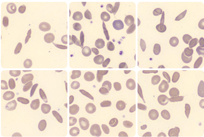 anemia falciforme