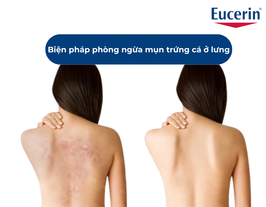 Mụn trứng cá ở lưng