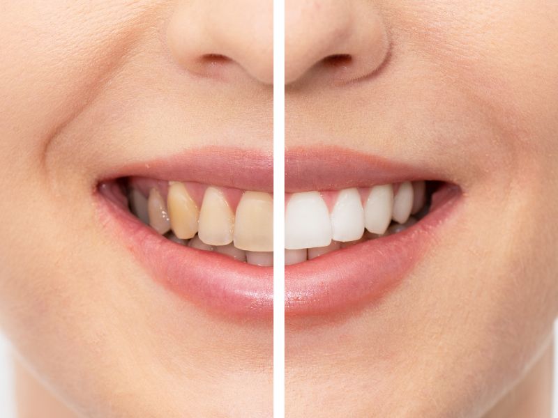 quanto tempo dura um clareamento dental o que é e como funciona