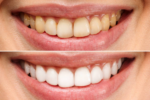 How to Whiten Teeth in a Photo