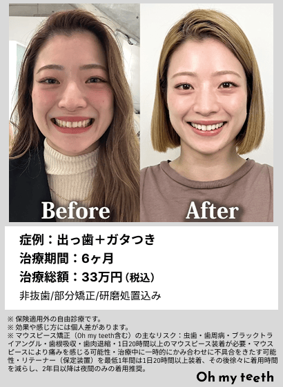 全顔BA・出っ歯＋ガタつき
