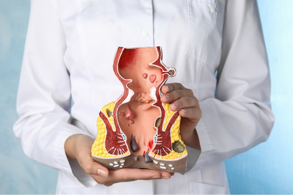 doctor holding up a model of colon depicting polyps and other growth which may indicate cancer