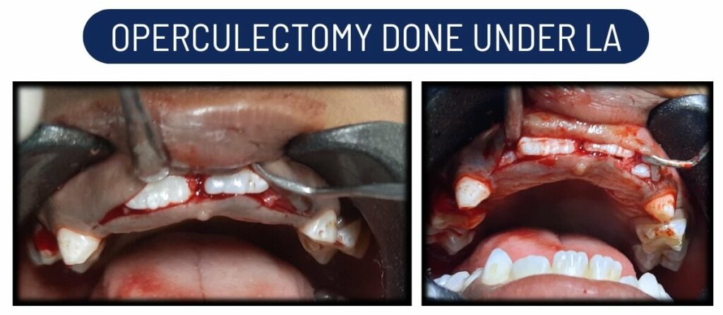 operculectomy