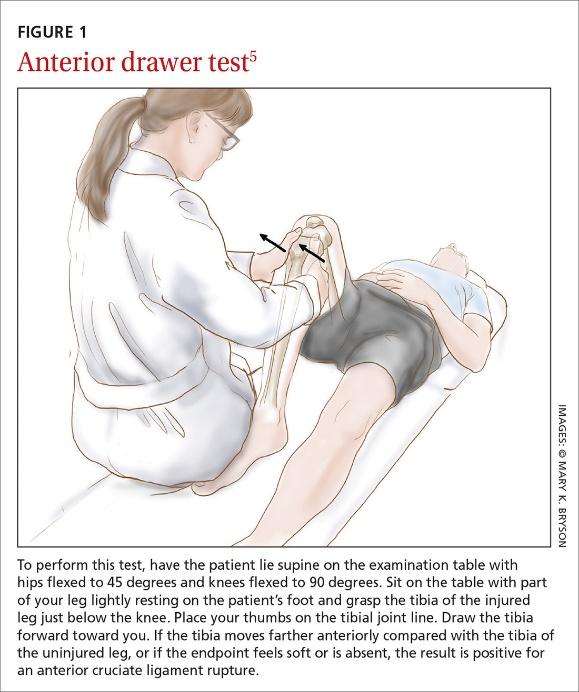 ACL injury: How do the physical examination tests compare? | MDedge Family  Medicine