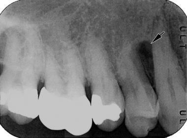 Lateral Periodontal Cyst Pathology: Definition, Epidemiology, Etiology