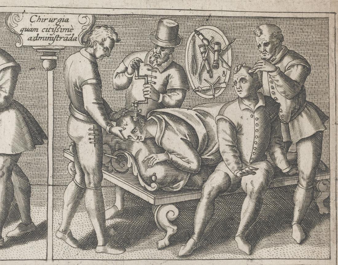 Trepanation: Our ancestors' idea of neurosurgery