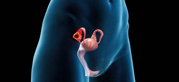 Représentation médicale en 3D du corps d'une femme atteinte d'un cancer de l'ovaire.