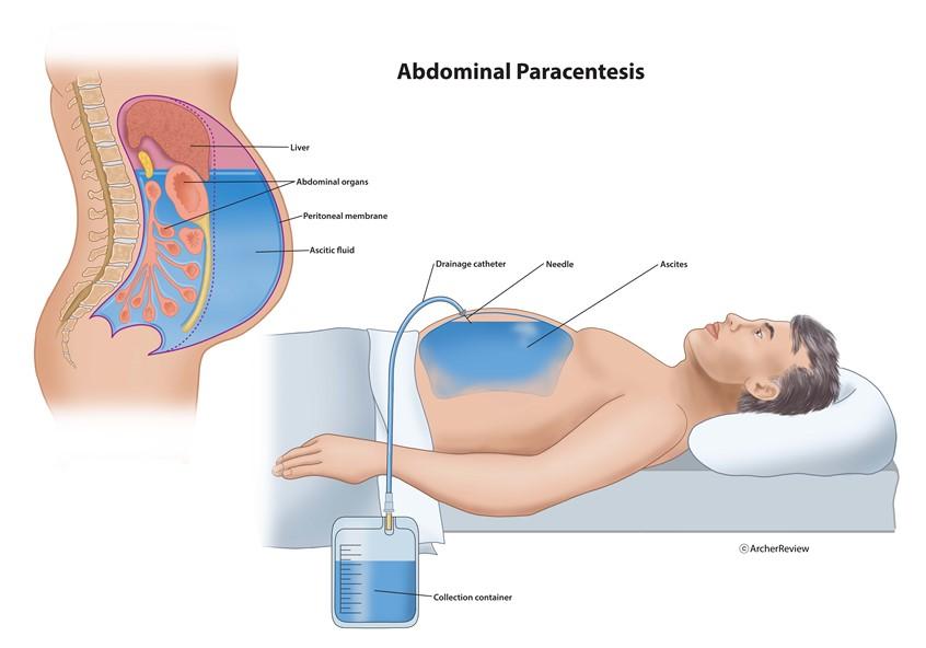 Abdominal Paracentesis Illustration by Suzanne Hayes | Medical Illustration & Animation