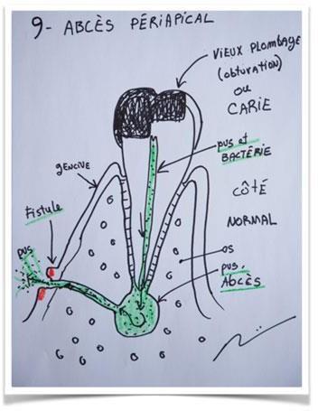 abces-periapical-dr-villemaire-sherbrooke.jpg