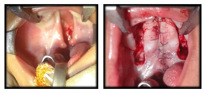 palatoplasty ajisha