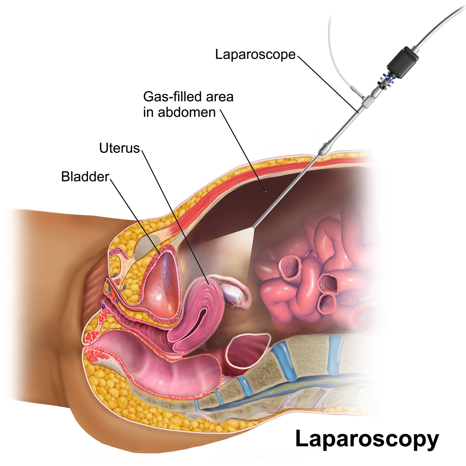 Laparoscopy - Wikipedia