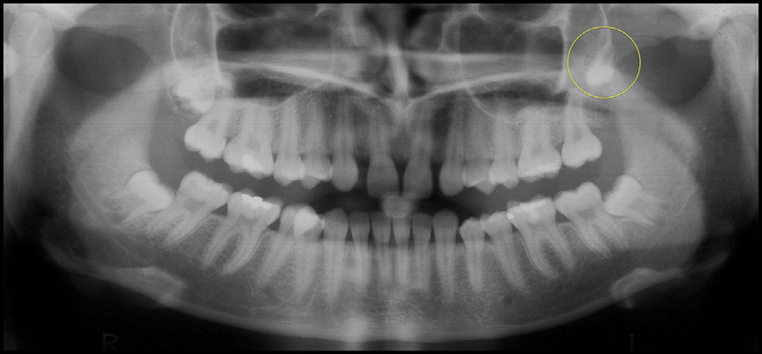 Panoramic radiograph showing congenital absence of the maxillary... |  Download Scientific Diagram