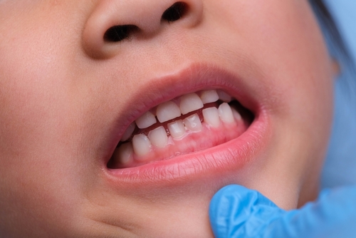 Gum Disease
