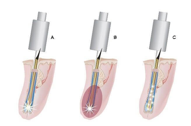 Illustration of the different types of an electrolysis permanent hair removal session