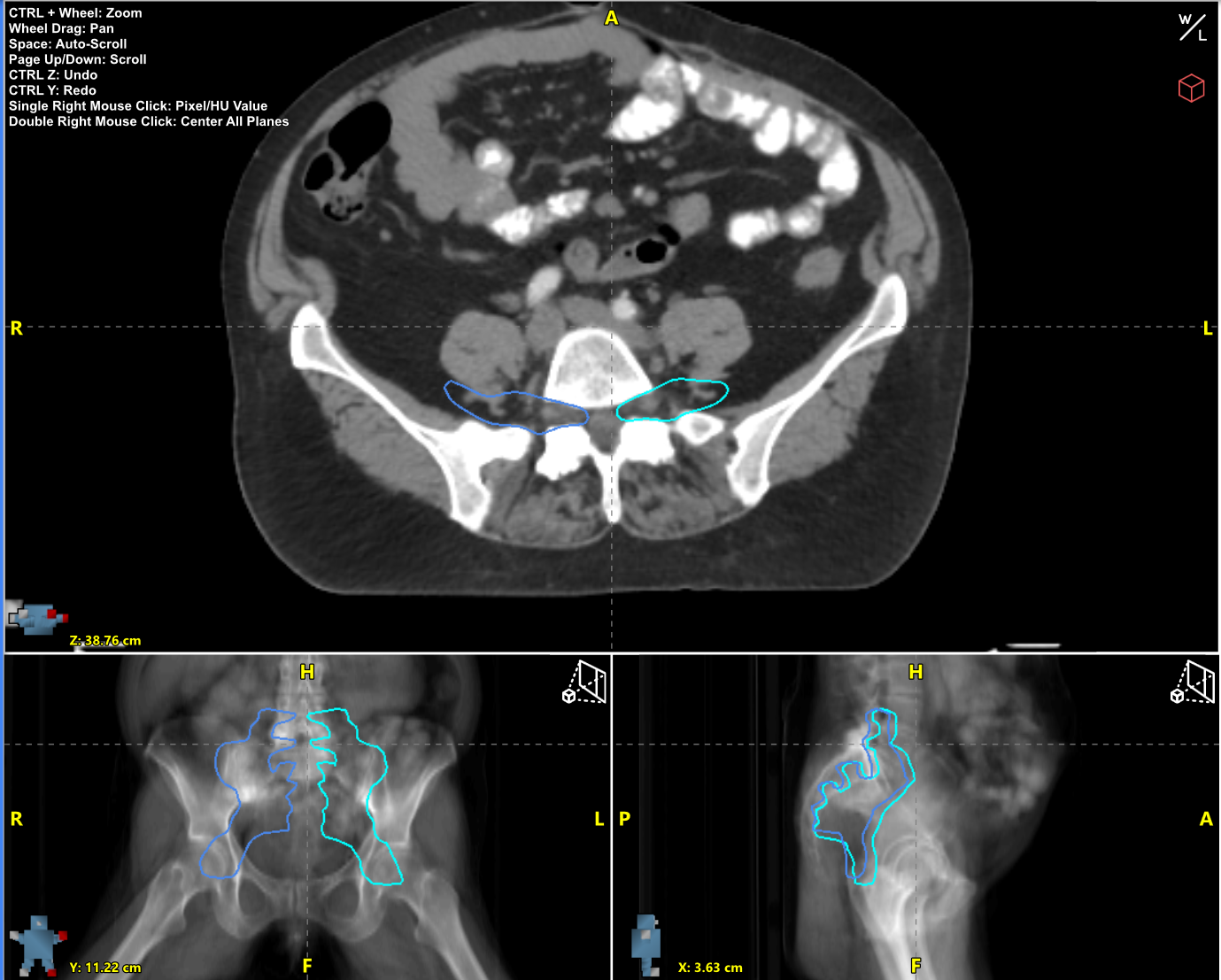 AutoContour Radformation Sacral Plexus