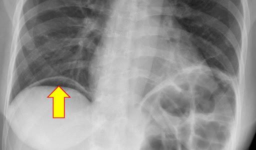Post operative pneumoperitoneum – Radiology Cases
