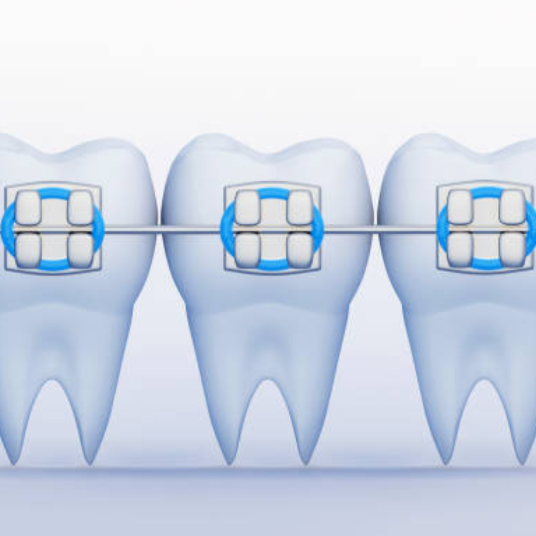 Braces For Adults