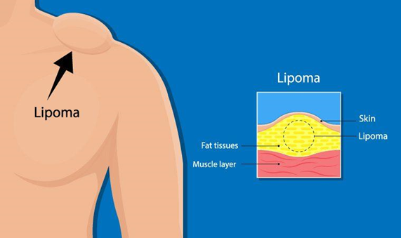 what is lipoma, Picture