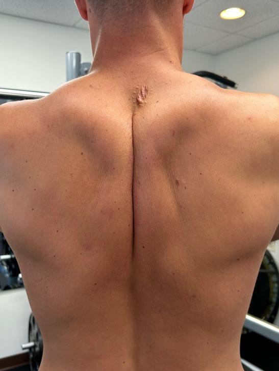 A person with a scar on his back Description automatically generated