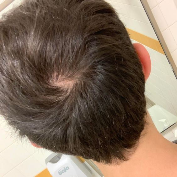 Cowlick hair pattern