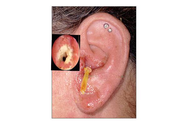 Otitis Externa