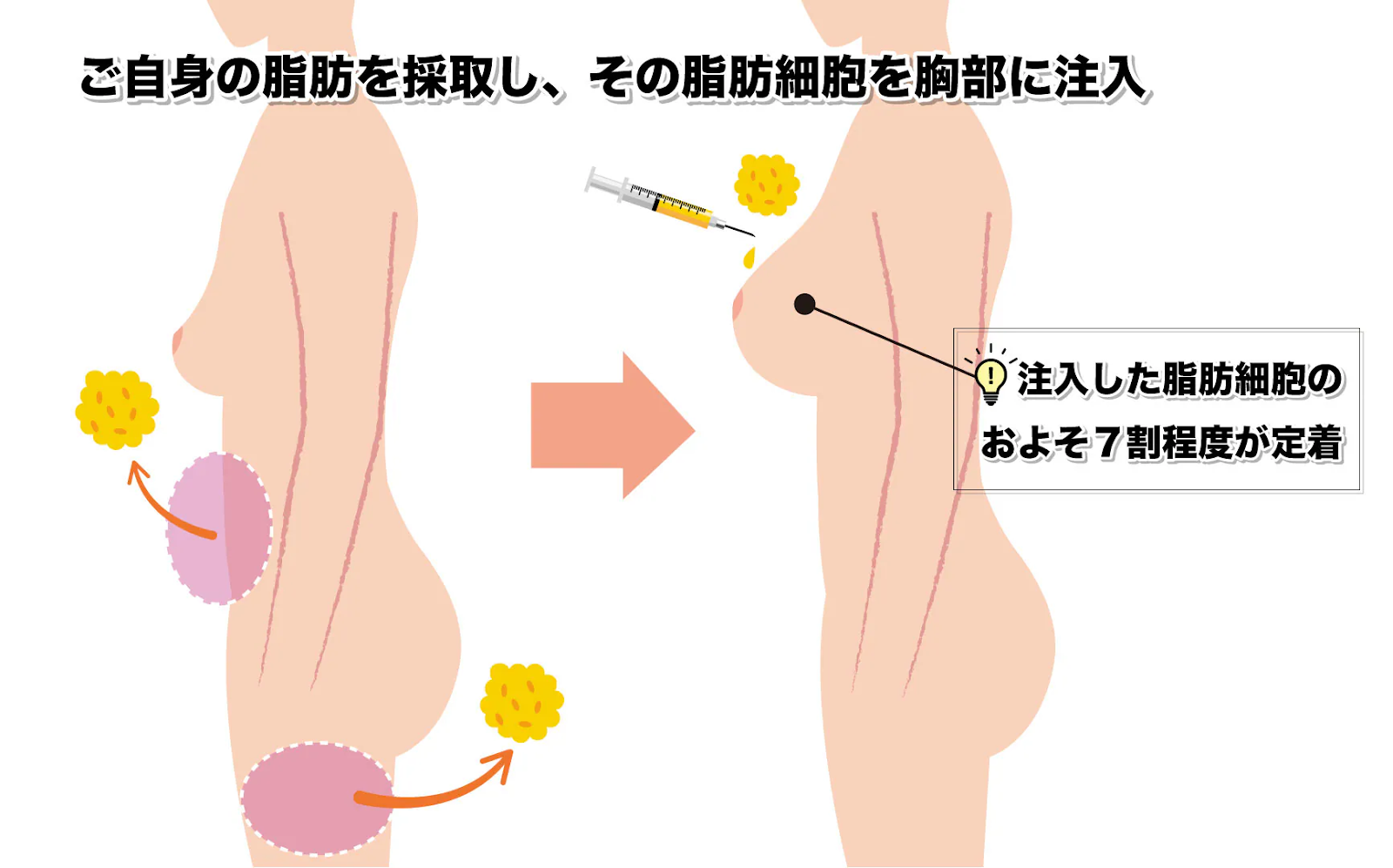 脂肪注入豊胸術とは？