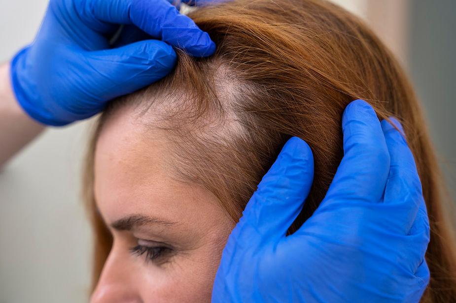 A doctor is examining scalp of female hair thinning