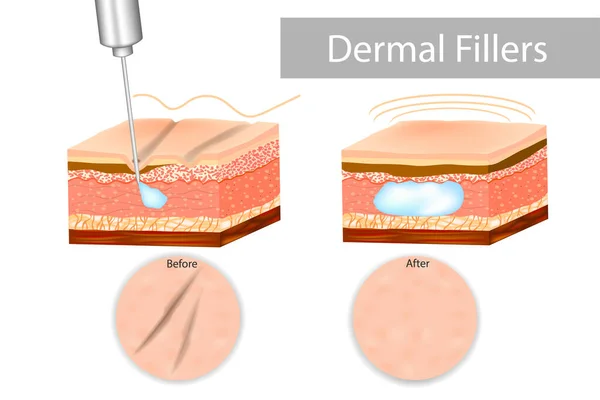 Types of Fillers Used for Acne Scars
