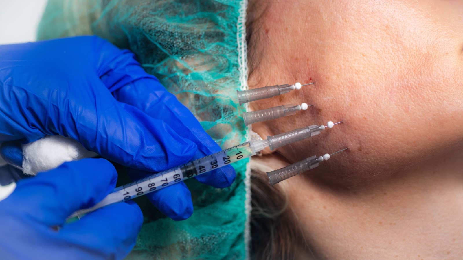 dermal fillers cheek