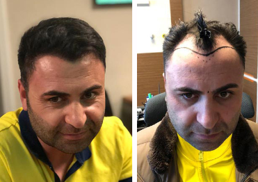 زراعة الشعر للسيد مراد - مركز اليت هير لزراعة الشعر