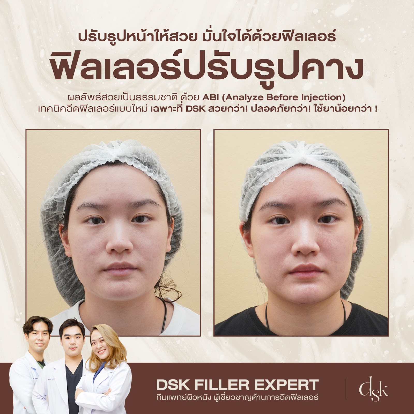 รีวิวฟิลเลอร์คางที่ DSK Clinic