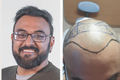 نتائج زراعة الشعر لخليل البلوشي - مركز اليت هير لزراعة الشعر