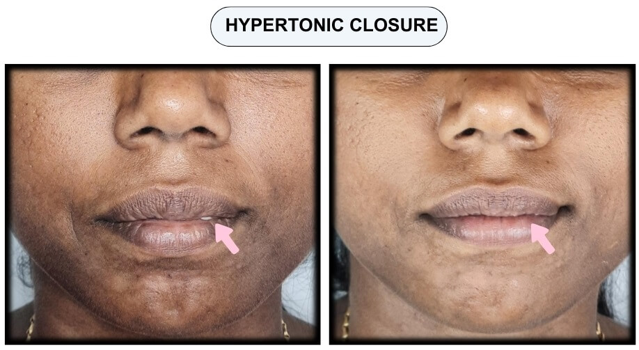 hypertonic closure