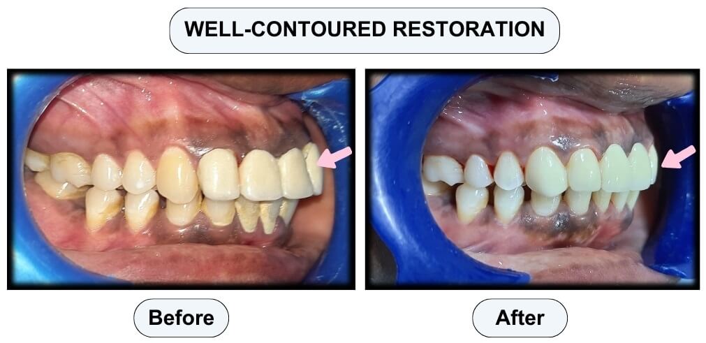 contoured restoration