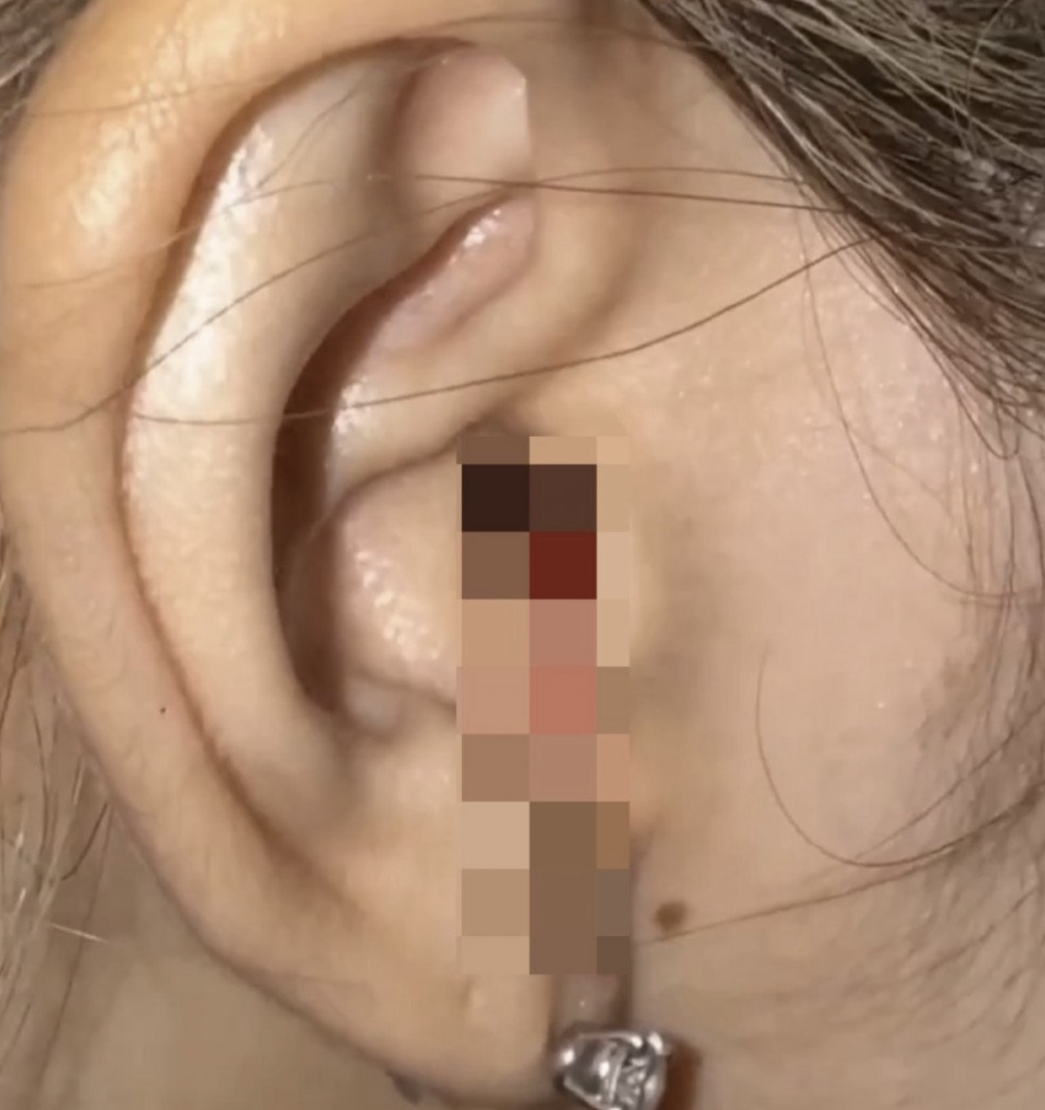 A picture BLACKPINK's Lisa Bleeding Ear