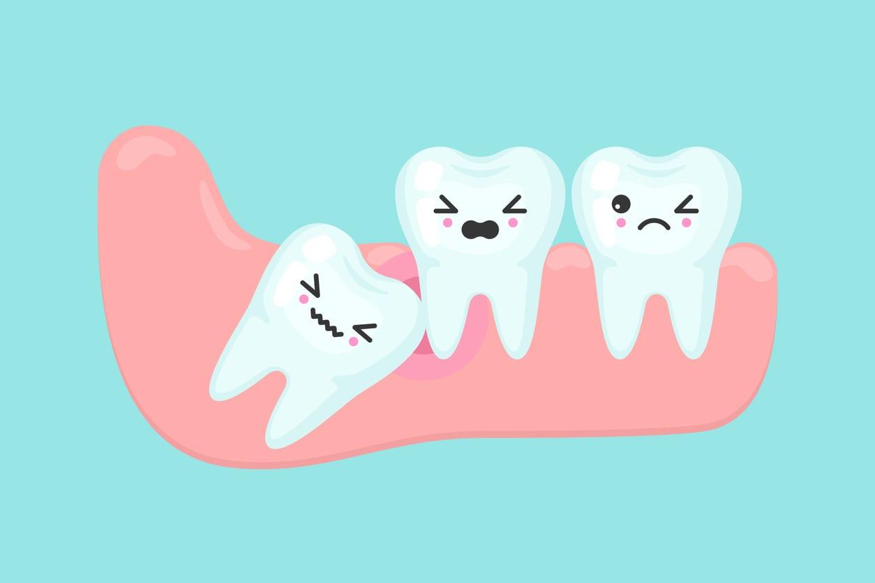 Wisdom teeth removal cost in Burnaby