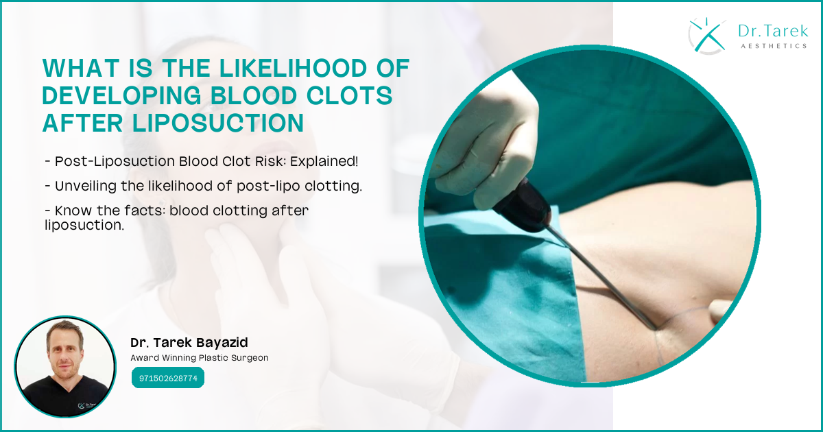 Can Liposuction Cause Blood Clots