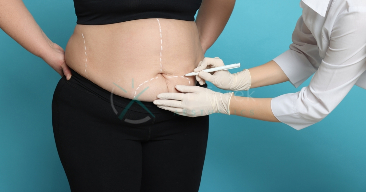 Are There Side Effects Of Liposuction