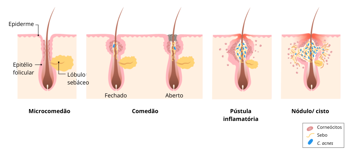 Fases do desenvolvimento da acne.