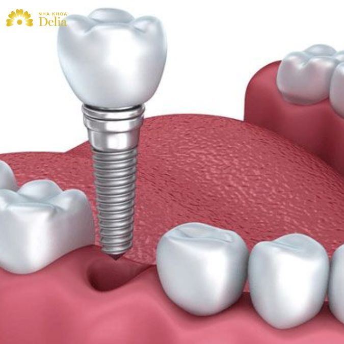 Cấy ghép Implant khôi phục hoàn hảo răng vĩnh viễn