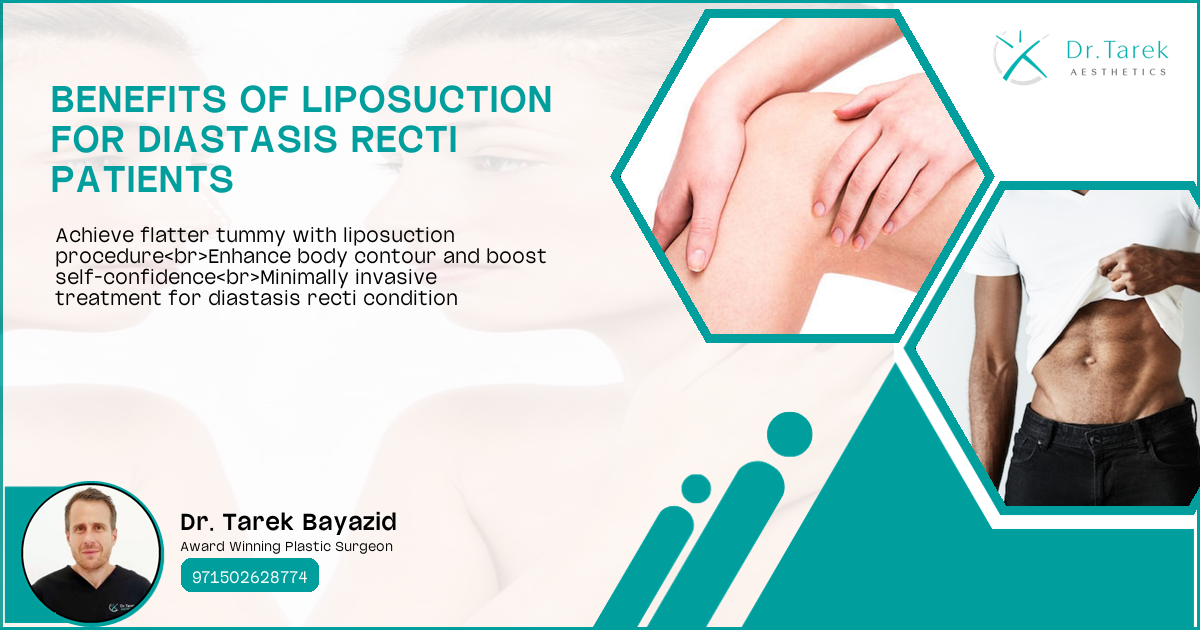 Can Liposuction Help Diastasis Recti