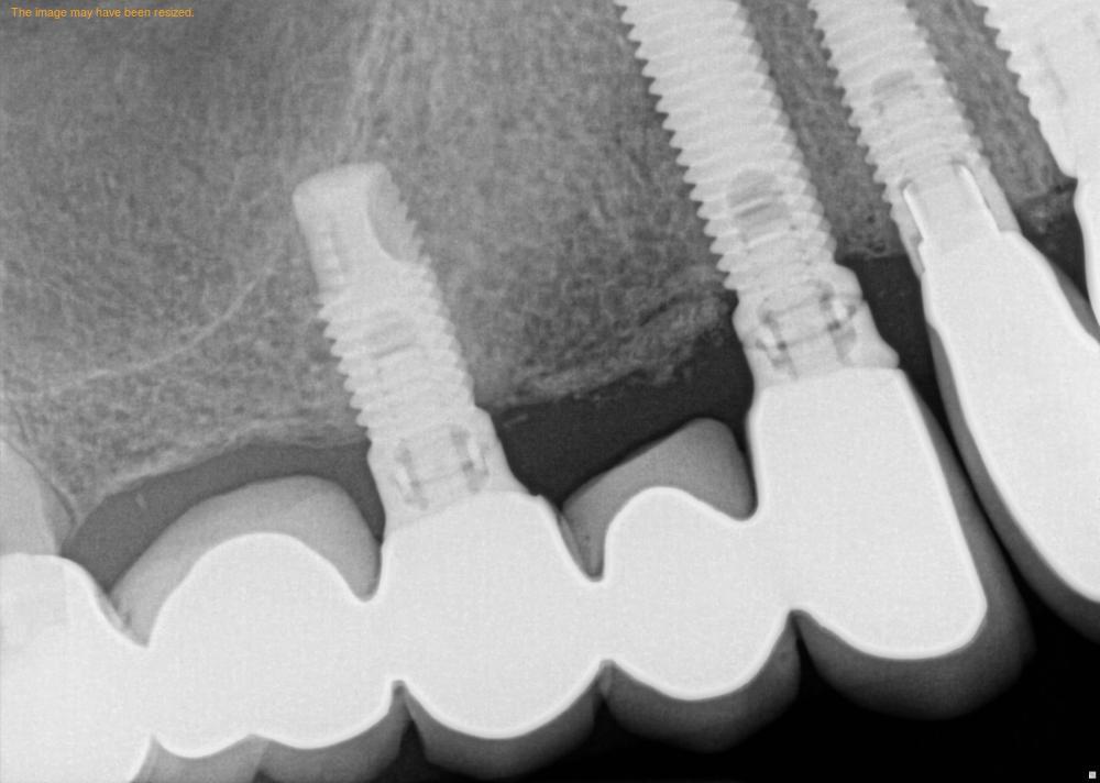 Dental Implant—X-ray