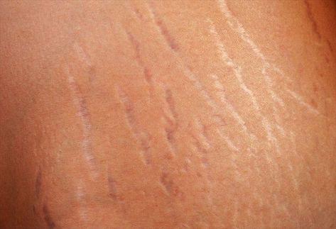 What are stretch marks?