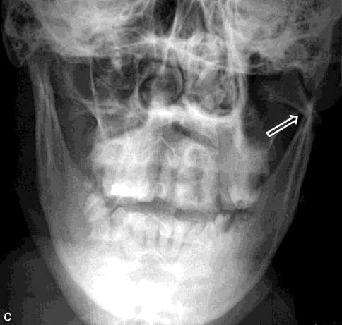 Résultat de recherche d'images pour "fracture mandibulaire  sur mordu occlusale"