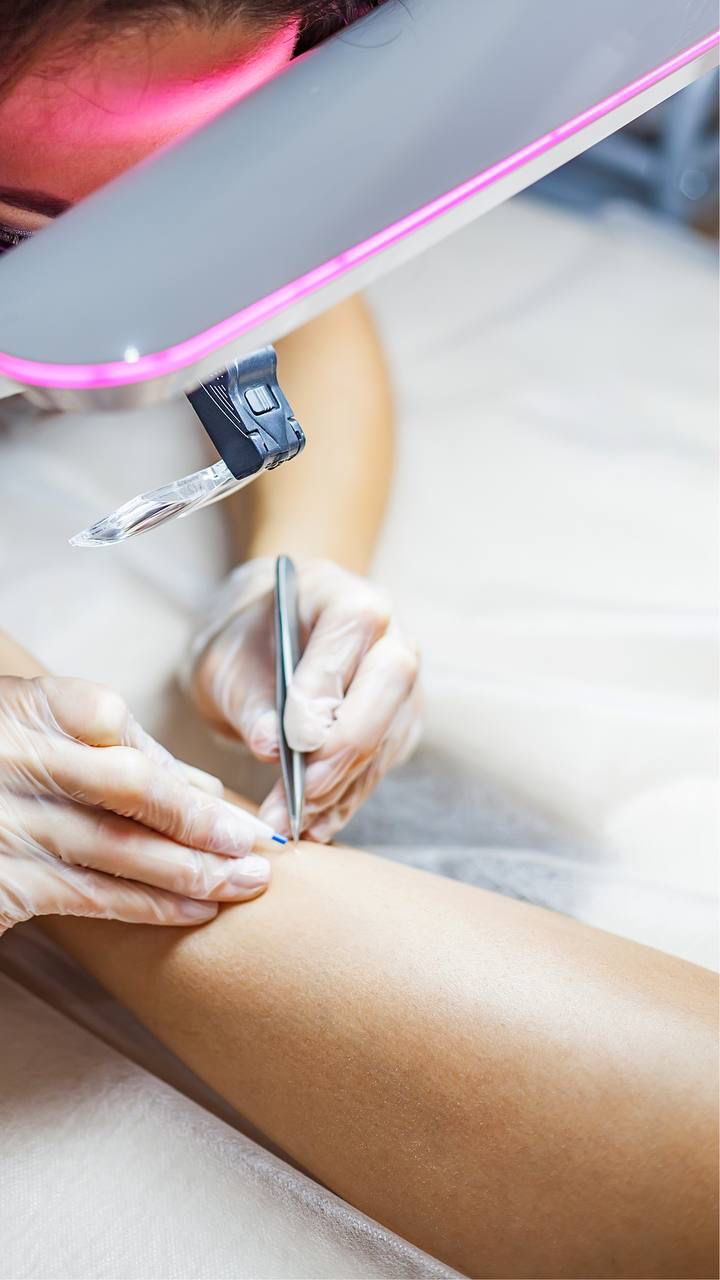 This contains an image of permanent hair removal using electrolysis.