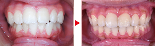 症例03矯正写真（前）、治療前→治療後