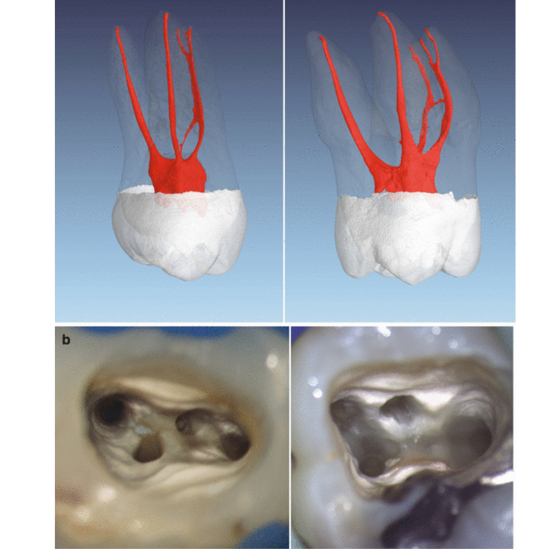Types of Root Canals Boston Patients Commonly Need