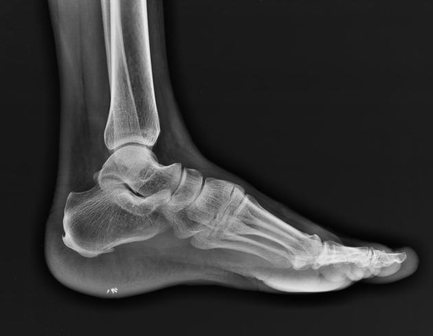 X-ray of a foot

Description automatically generated