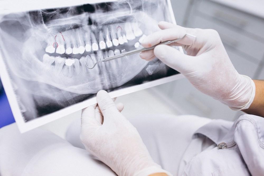 ¿Necesitas reemplazar dientes perdidos? Conoce aquí cuándo considerar los implantes dentales y explora sus ventajas.