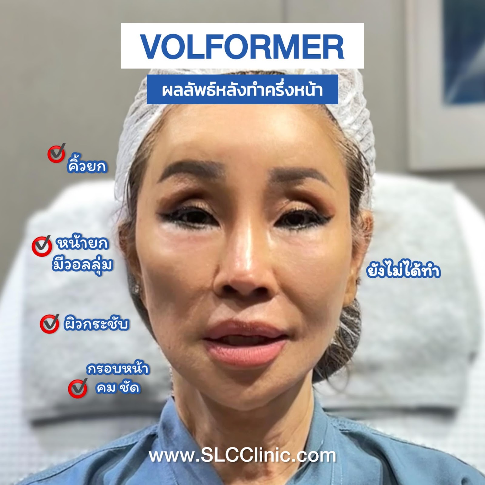 Volnewmer, MPT4DLift, Volformer, SLC Clinic